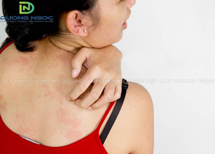 Các bệnh lý về da do quần áo kém chất lượng